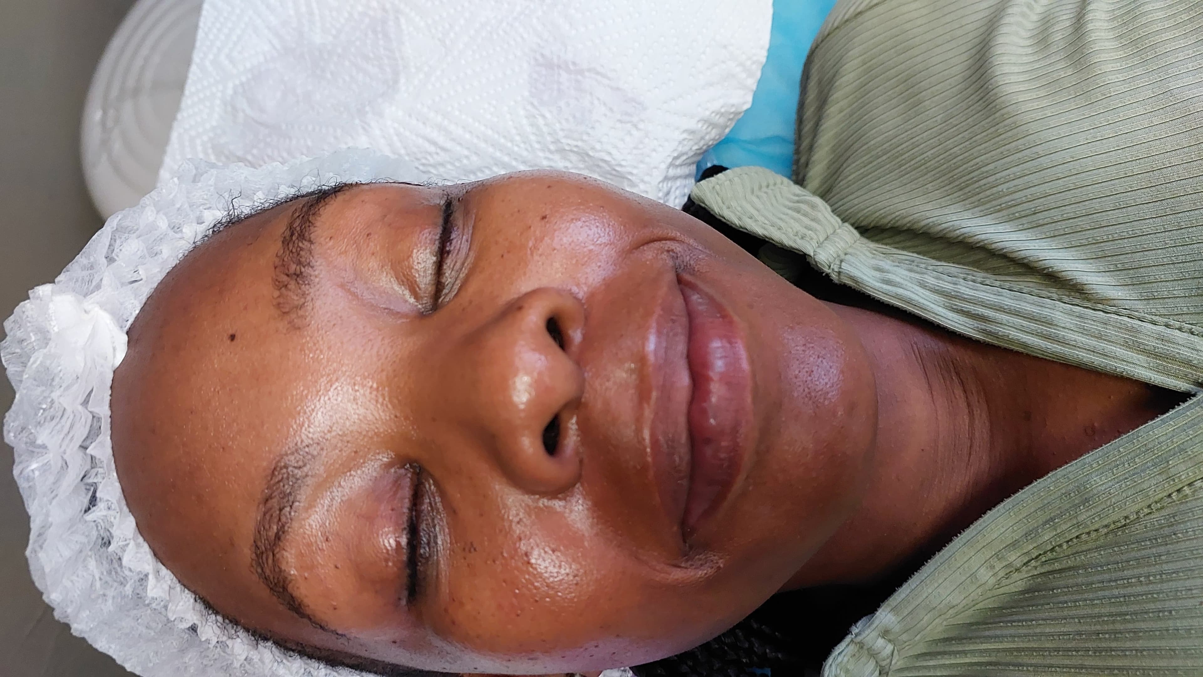 Dermaplaning