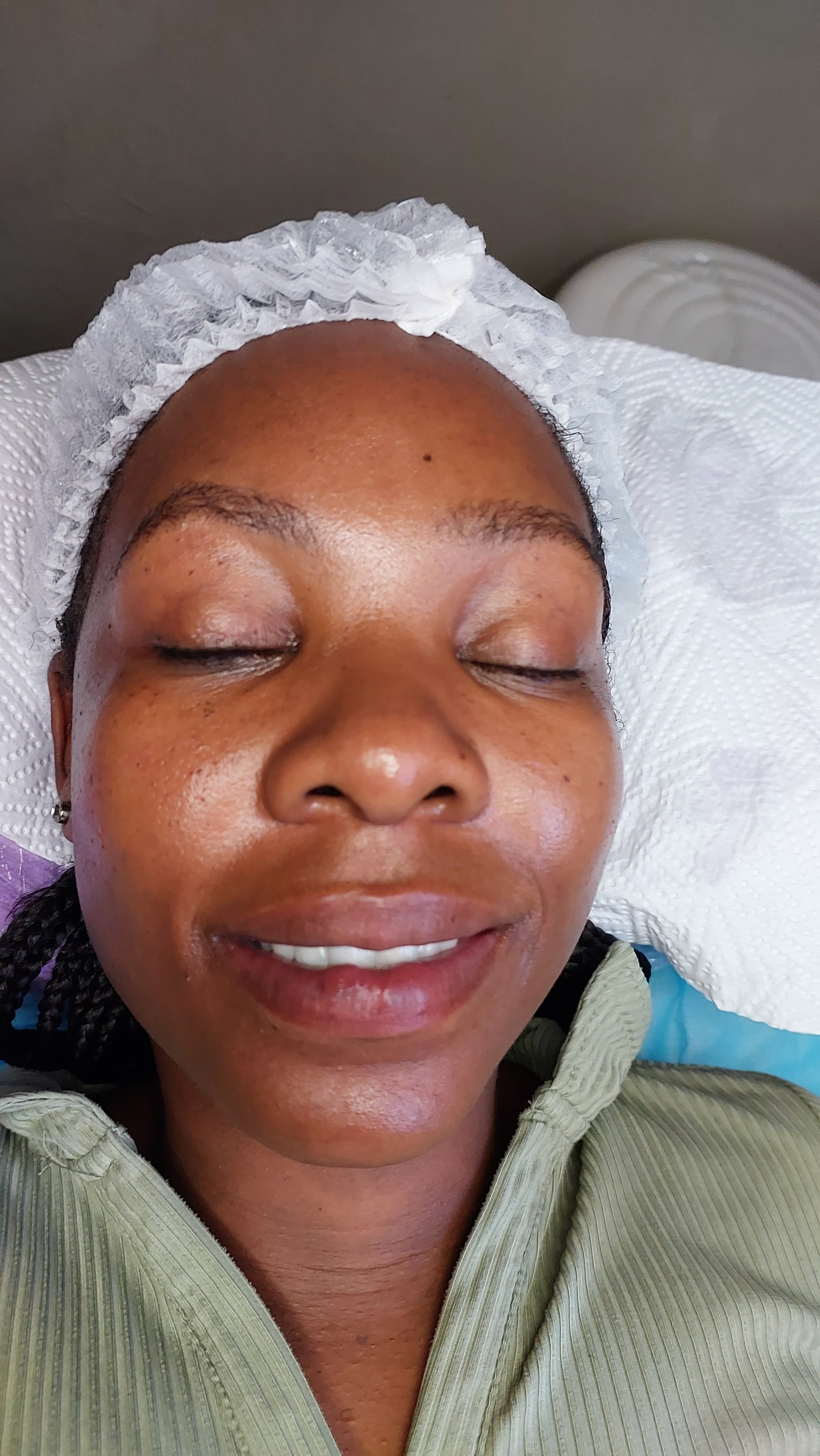 Dermaplaning